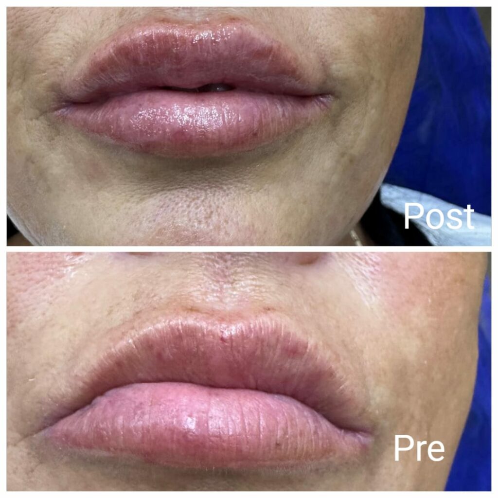 فيلر الشفاه قبل وبعد